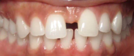 before image